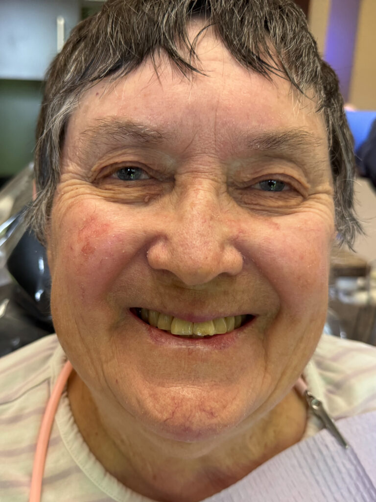 all porcelain veneers crown before after denton