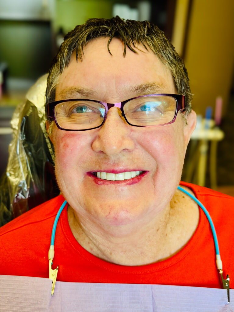Porcelain veneers and crowns smile makeover result on a patient with a chipped tooth in Denton.